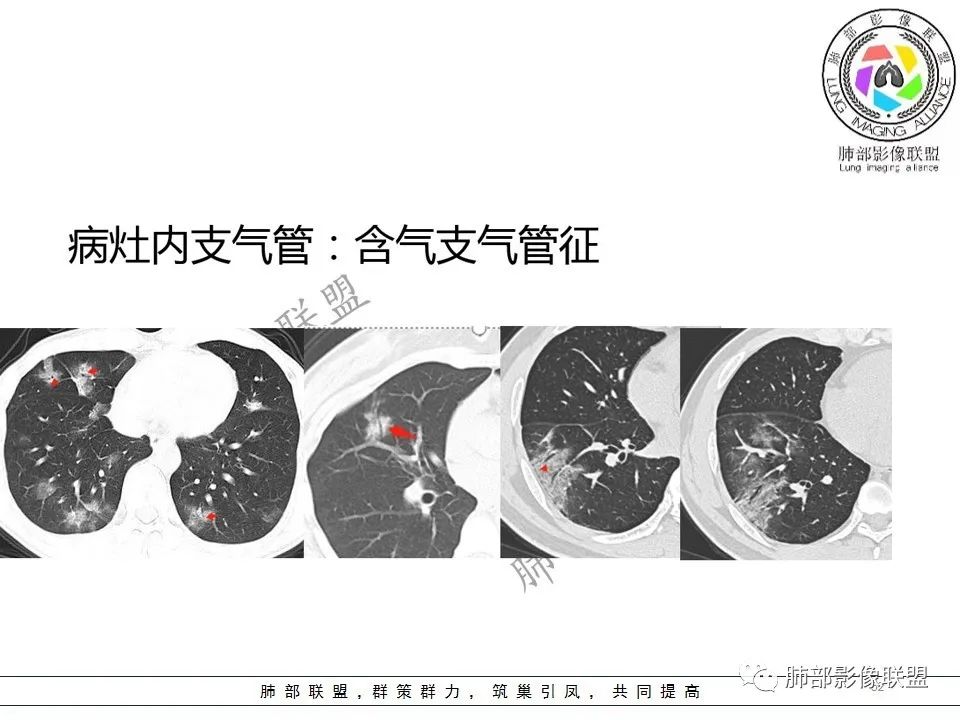 【PPT】关于180余例新冠肺炎(NCP)的影像分析与思考 【PPT】关于180余例新冠肺炎(NCP)的影像分析与思考