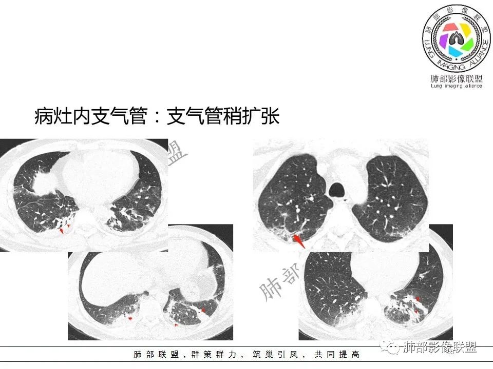 【PPT】关于180余例新冠肺炎(NCP)的影像分析与思考 【PPT】关于180余例新冠肺炎(NCP)的影像分析与思考