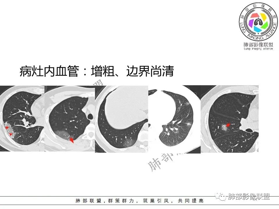 【PPT】关于180余例新冠肺炎(NCP)的影像分析与思考 【PPT】关于180余例新冠肺炎(NCP)的影像分析与思考