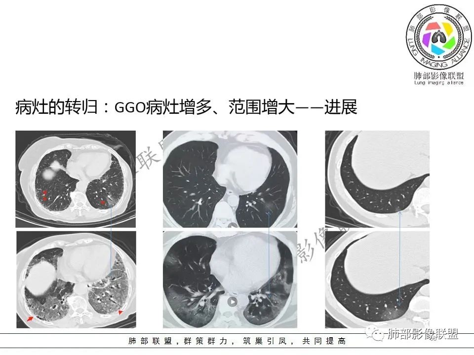 【PPT】关于180余例新冠肺炎(NCP)的影像分析与思考 【PPT】关于180余例新冠肺炎(NCP)的影像分析与思考