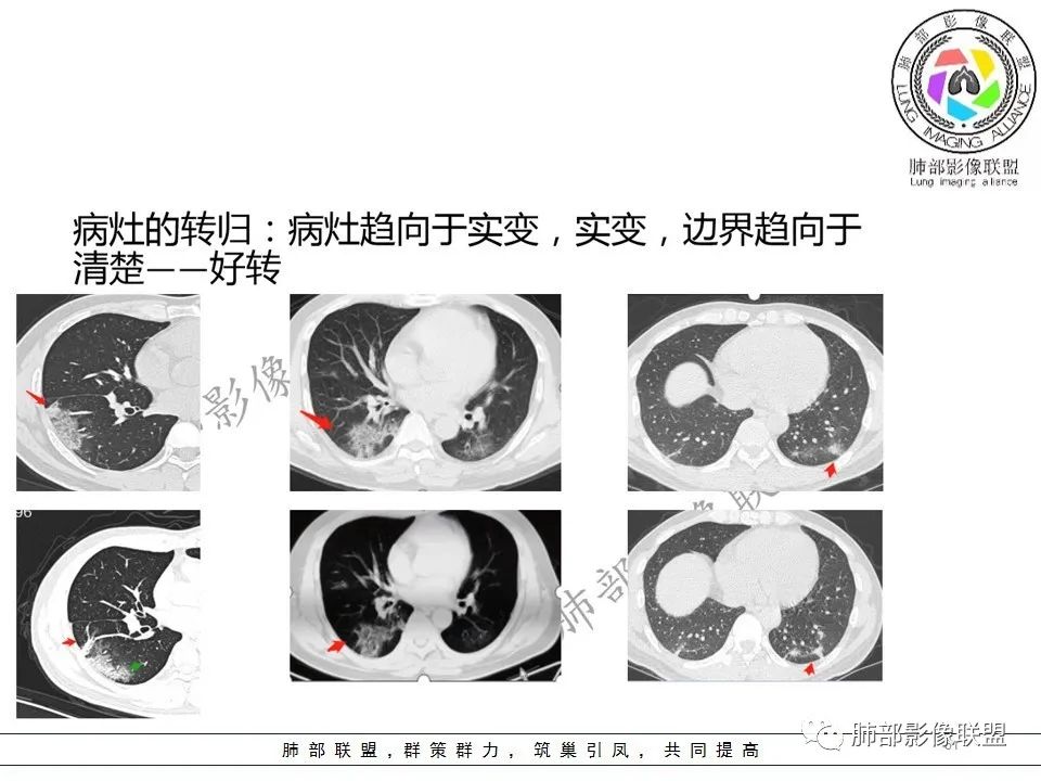 【PPT】关于180余例新冠肺炎(NCP)的影像分析与思考 【PPT】关于180余例新冠肺炎(NCP)的影像分析与思考