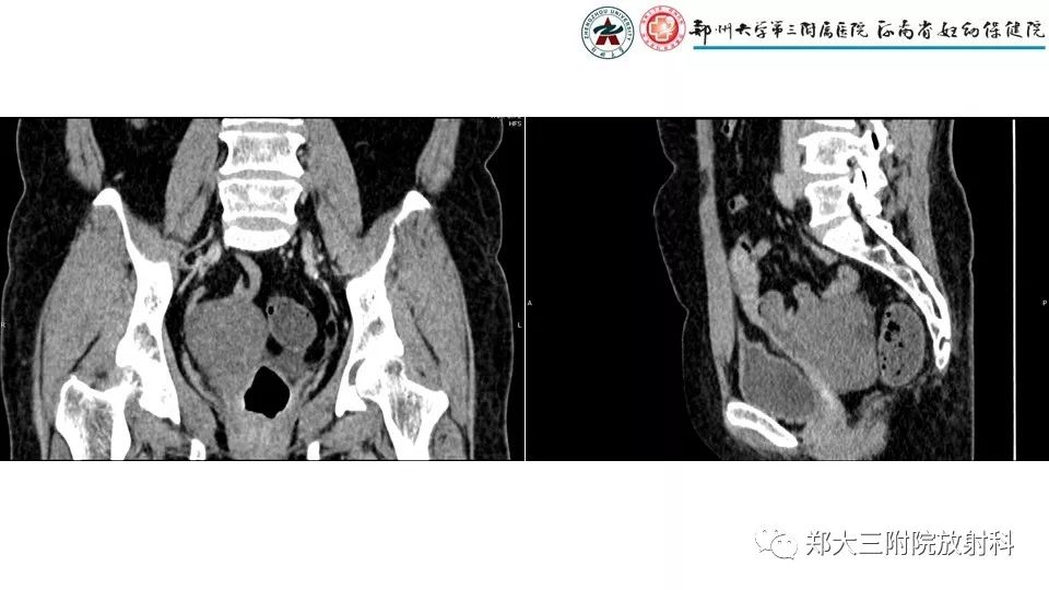 【病例】卵泡膜瘤1例CT影像