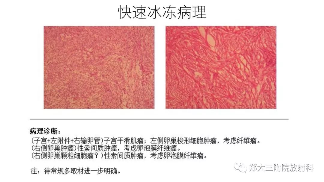 【病例】卵泡膜瘤1例CT影像