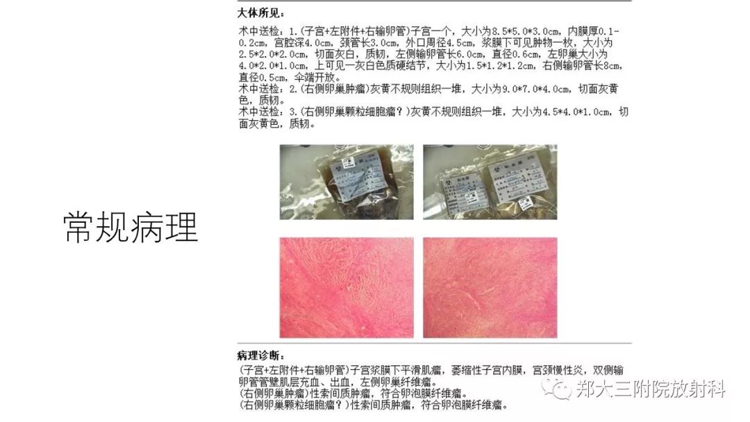 【病例】卵泡膜瘤1例CT影像