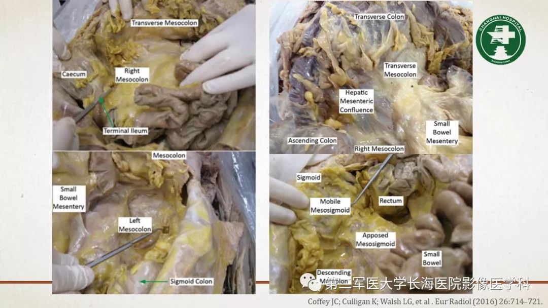 【PPT】腹膜相关结构的影像解剖
