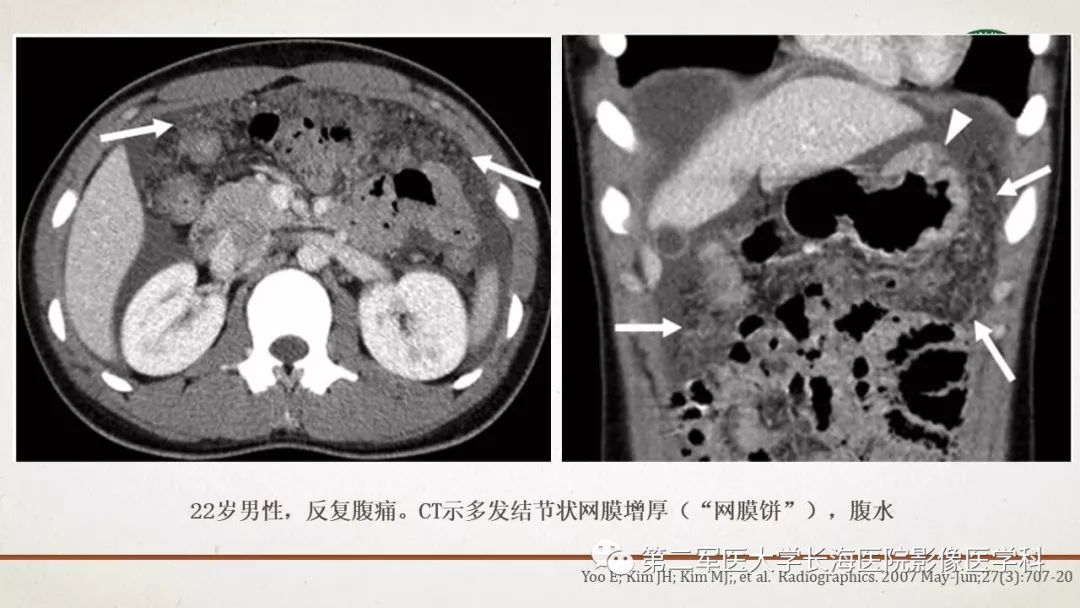 【PPT】腹膜相关结构的影像解剖