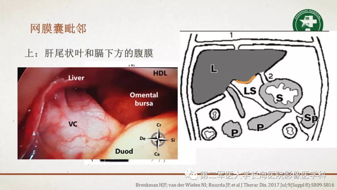 【PPT】腹膜相关结构的影像解剖