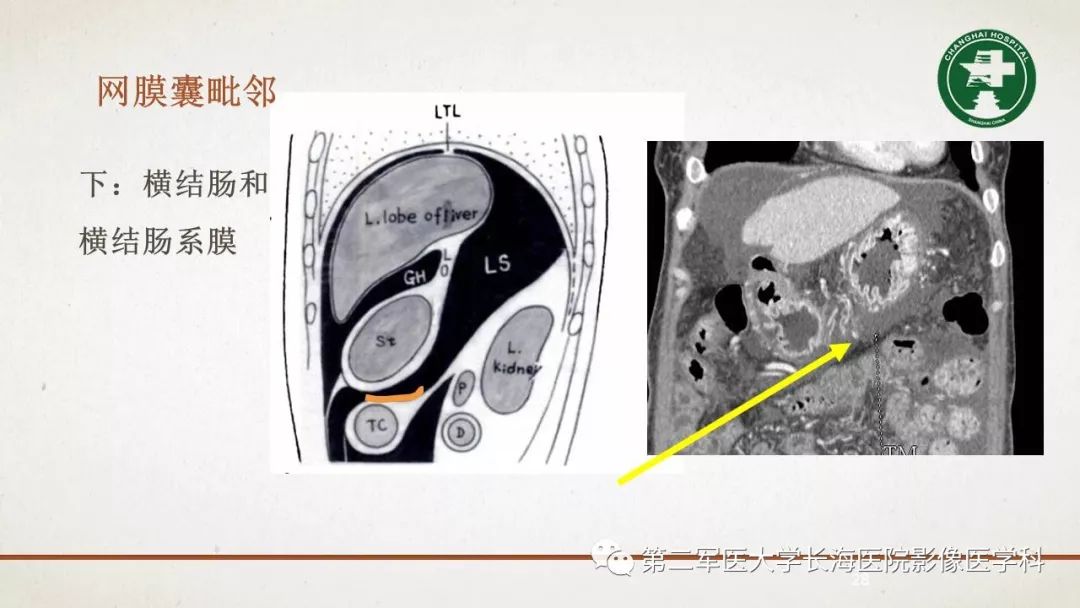 【PPT】腹膜相关结构的影像解剖