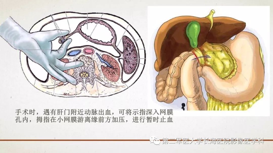 【PPT】腹膜相关结构的影像解剖