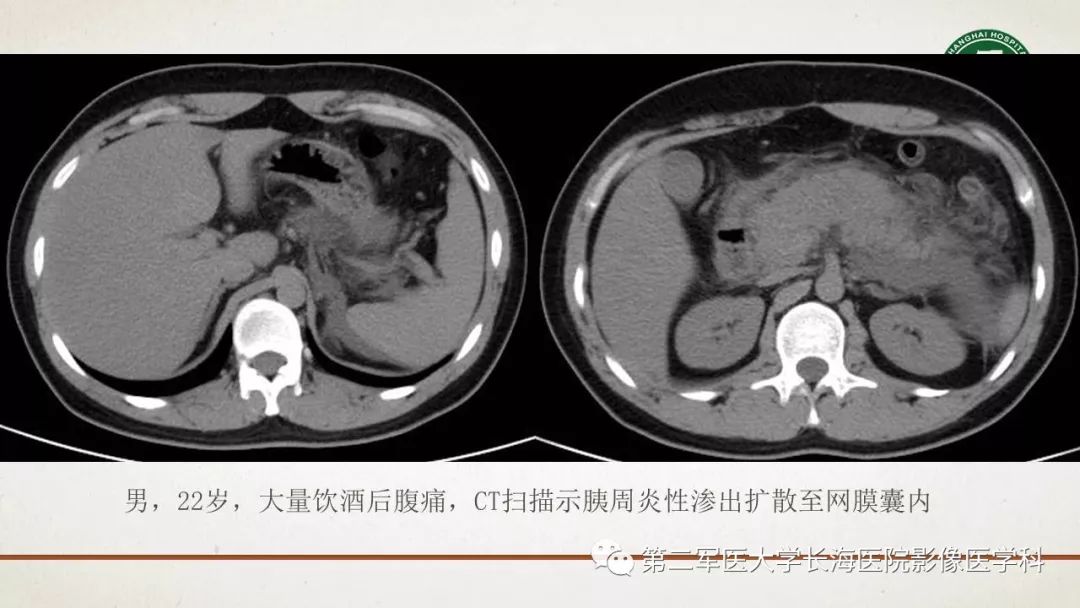 【PPT】腹膜相关结构的影像解剖