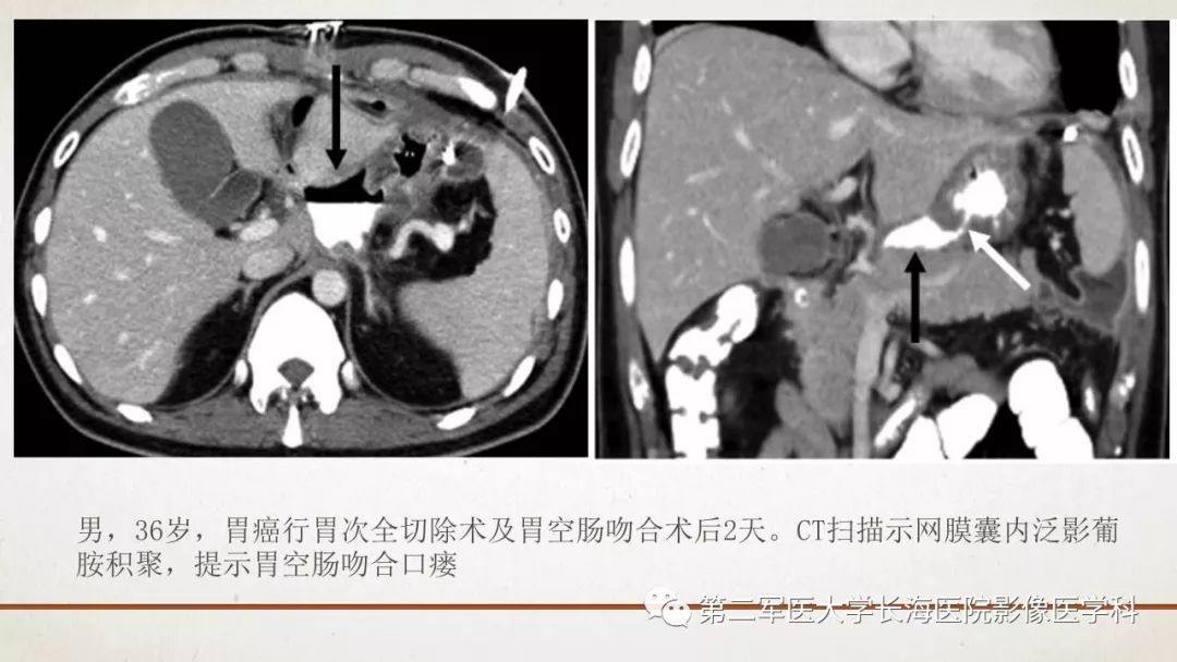 【PPT】腹膜相关结构的影像解剖