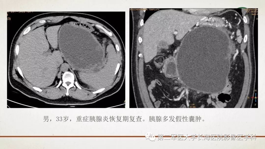 【PPT】腹膜相关结构的影像解剖