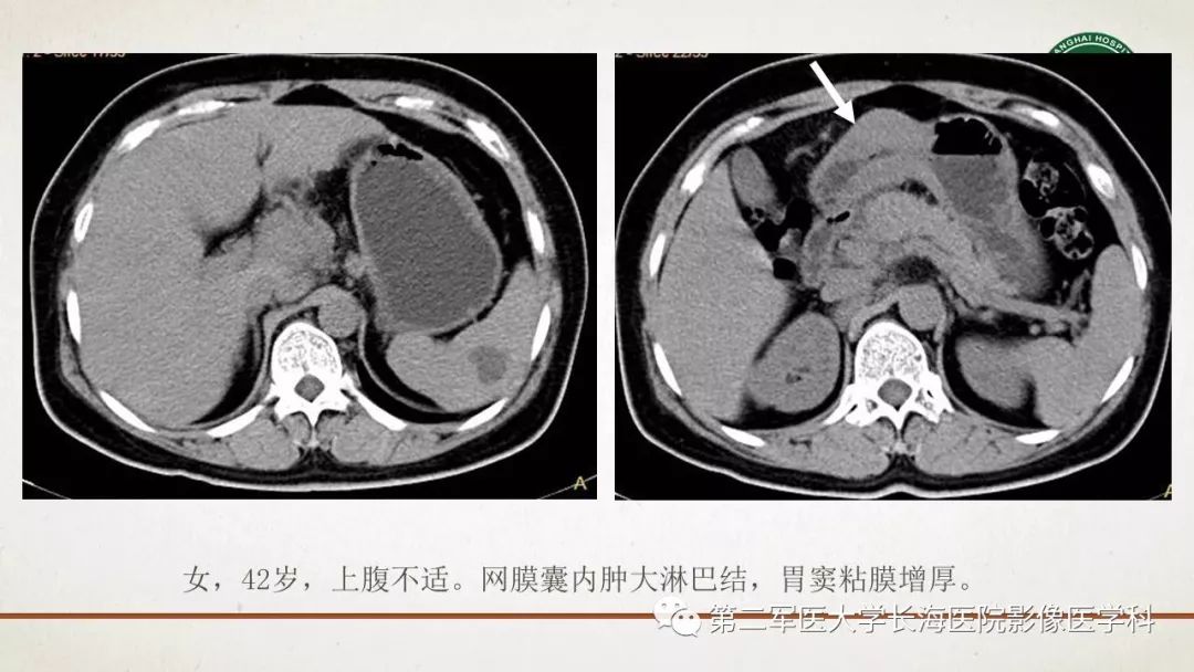 【PPT】腹膜相关结构的影像解剖