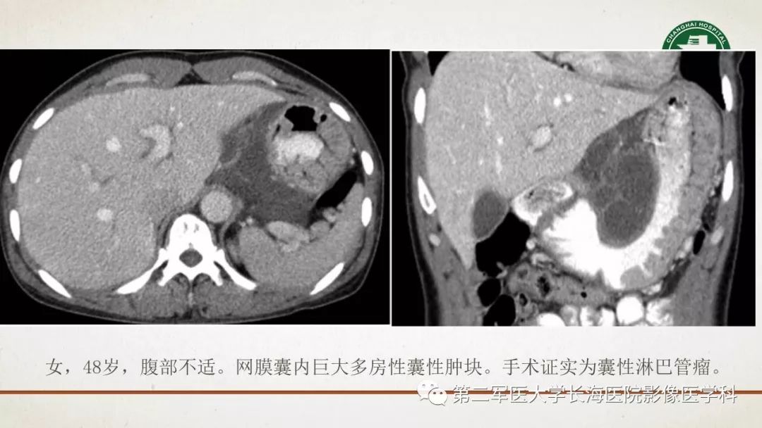 【PPT】腹膜相关结构的影像解剖