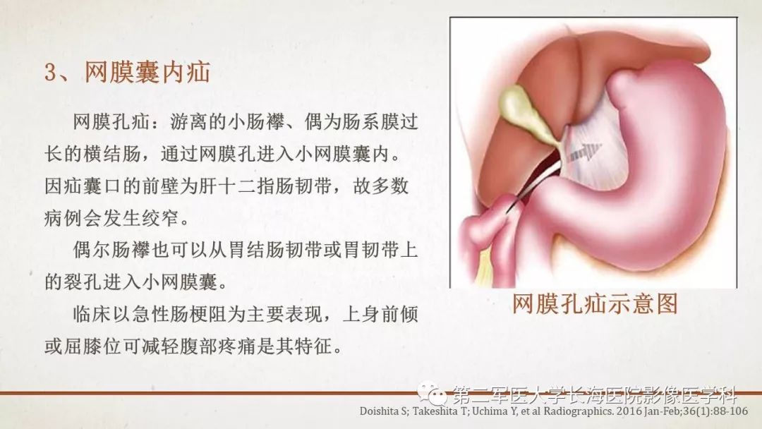 【PPT】腹膜相关结构的影像解剖
