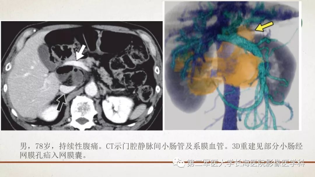 【PPT】腹膜相关结构的影像解剖