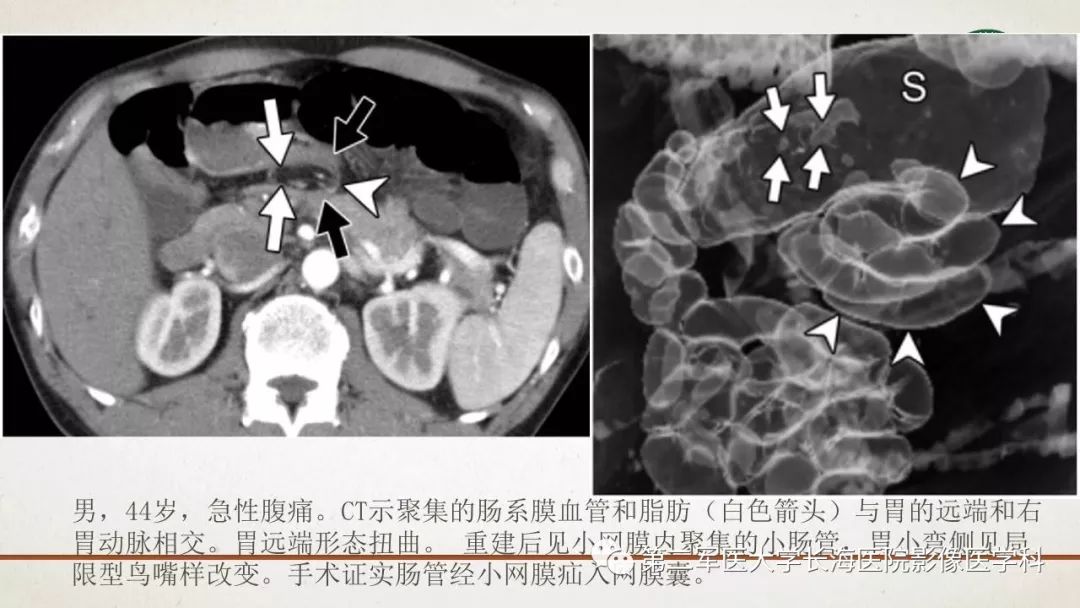 【PPT】腹膜相关结构的影像解剖