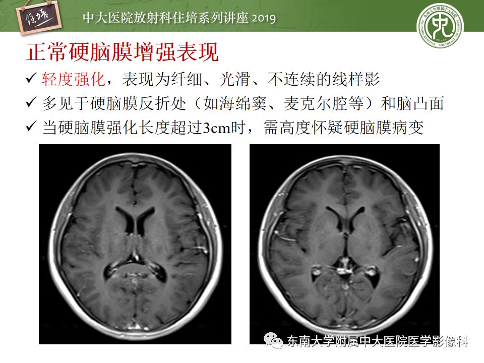 【PPT】脑膜异常强化及相关病变影像表现