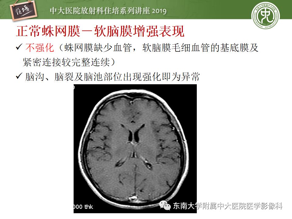 【PPT】脑膜异常强化及相关病变影像表现