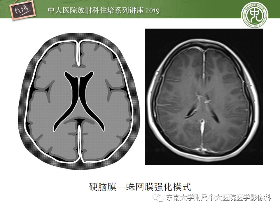 【PPT】脑膜异常强化及相关病变影像表现