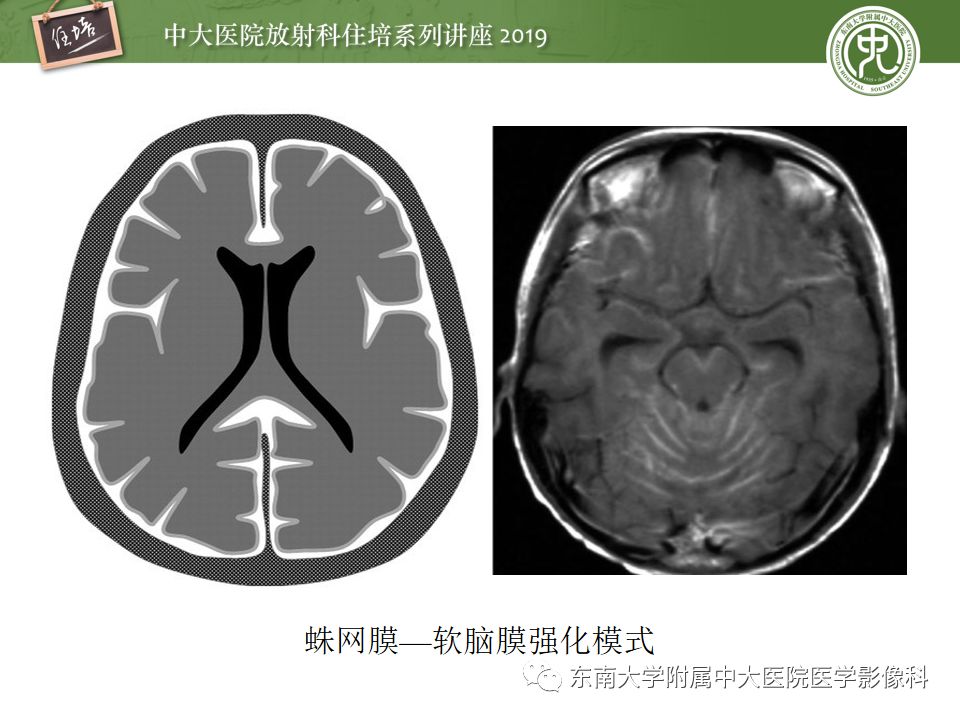 【PPT】脑膜异常强化及相关病变影像表现