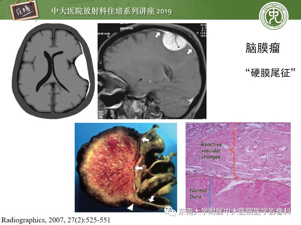 【PPT】脑膜异常强化及相关病变影像表现