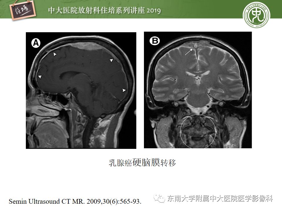 【PPT】脑膜异常强化及相关病变影像表现