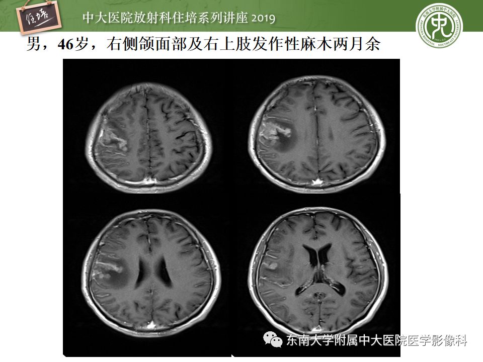 【PPT】脑膜异常强化及相关病变影像表现