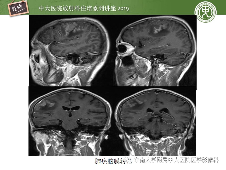 【PPT】脑膜异常强化及相关病变影像表现
