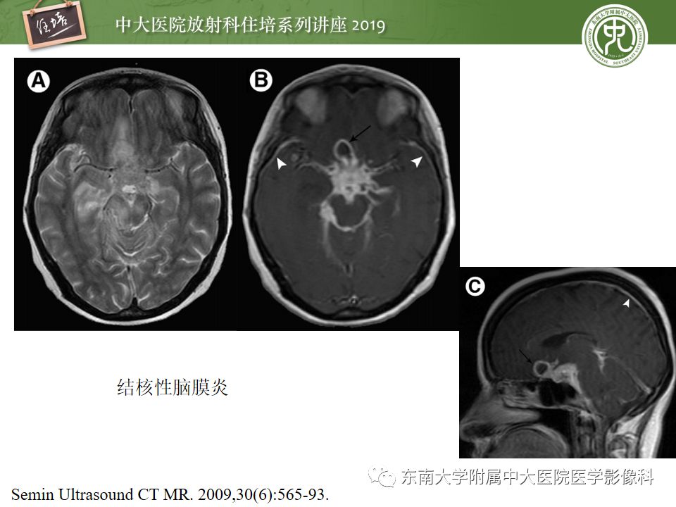 【PPT】脑膜异常强化及相关病变影像表现