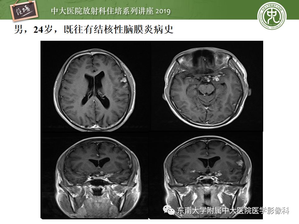 【PPT】脑膜异常强化及相关病变影像表现