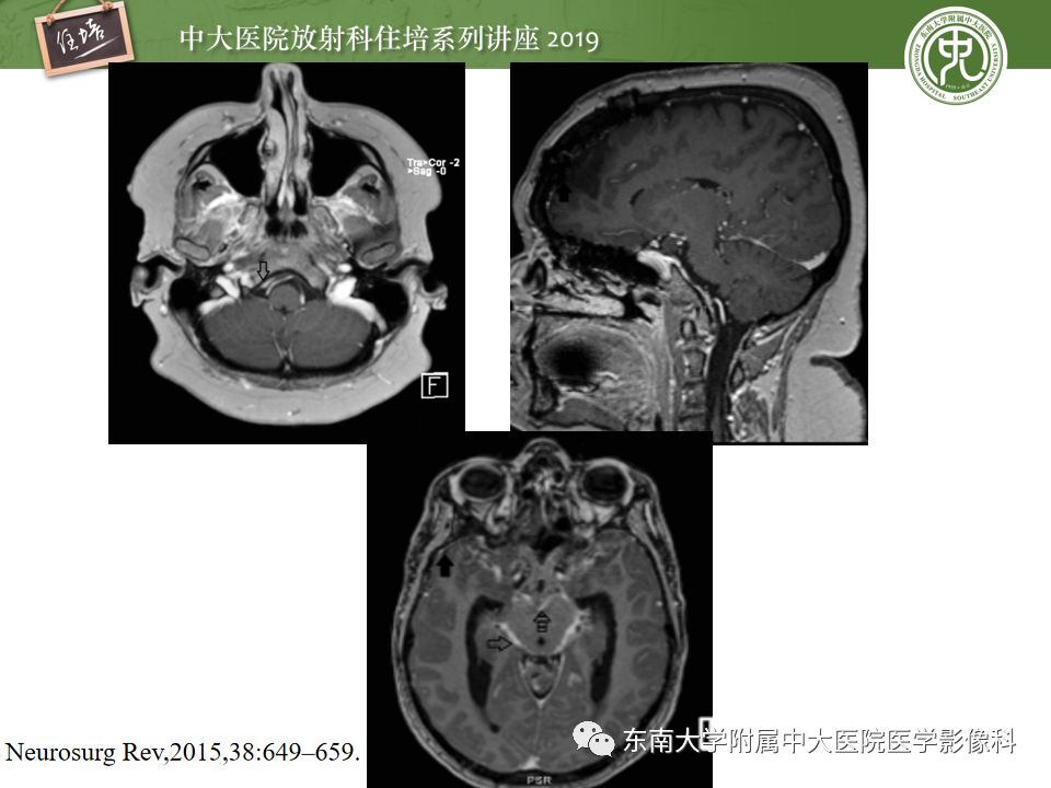 【PPT】脑膜异常强化及相关病变影像表现