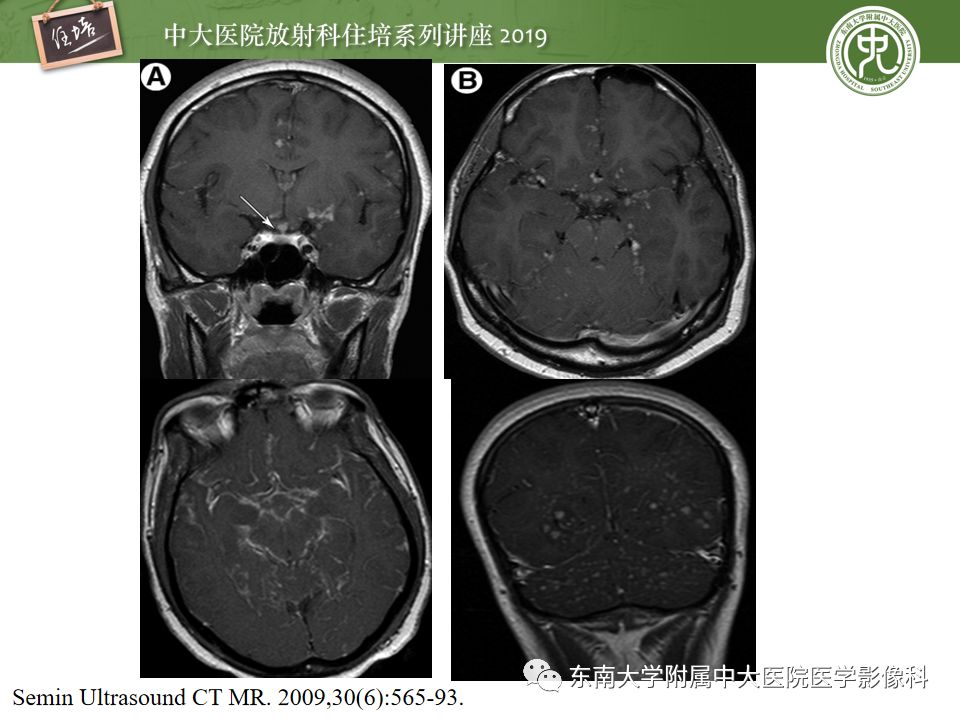【PPT】脑膜异常强化及相关病变影像表现