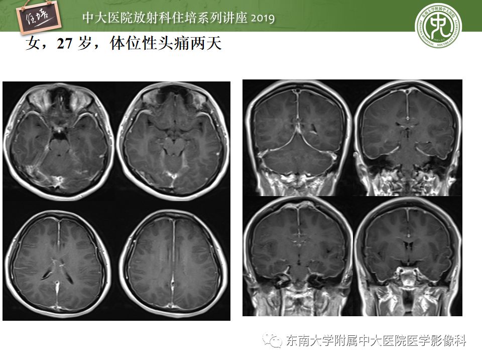 【PPT】脑膜异常强化及相关病变影像表现