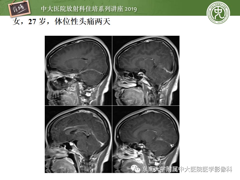 【PPT】脑膜异常强化及相关病变影像表现