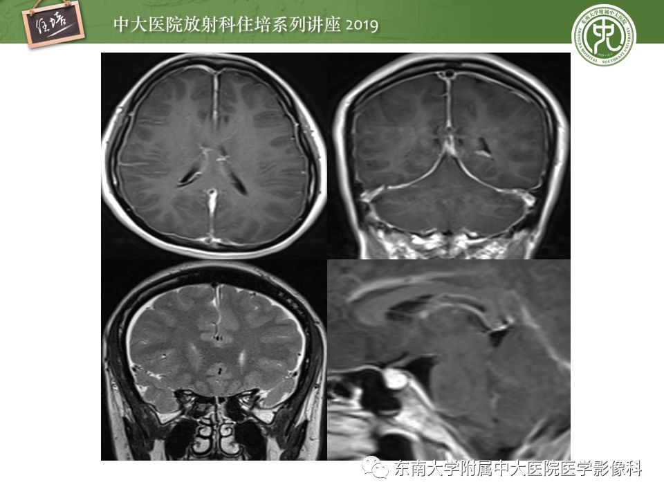 【PPT】脑膜异常强化及相关病变影像表现