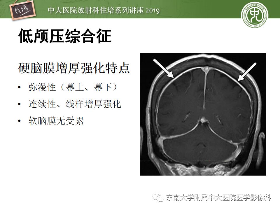 【PPT】脑膜异常强化及相关病变影像表现