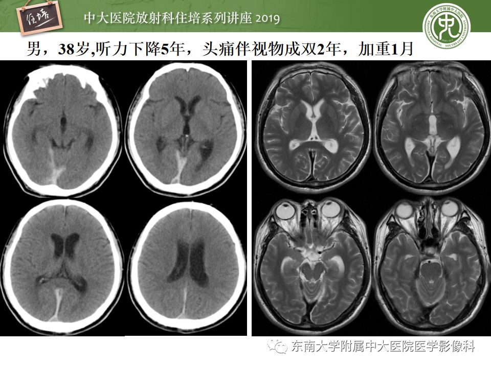【PPT】脑膜异常强化及相关病变影像表现