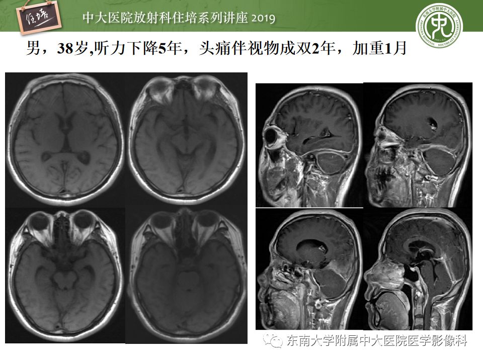 【PPT】脑膜异常强化及相关病变影像表现