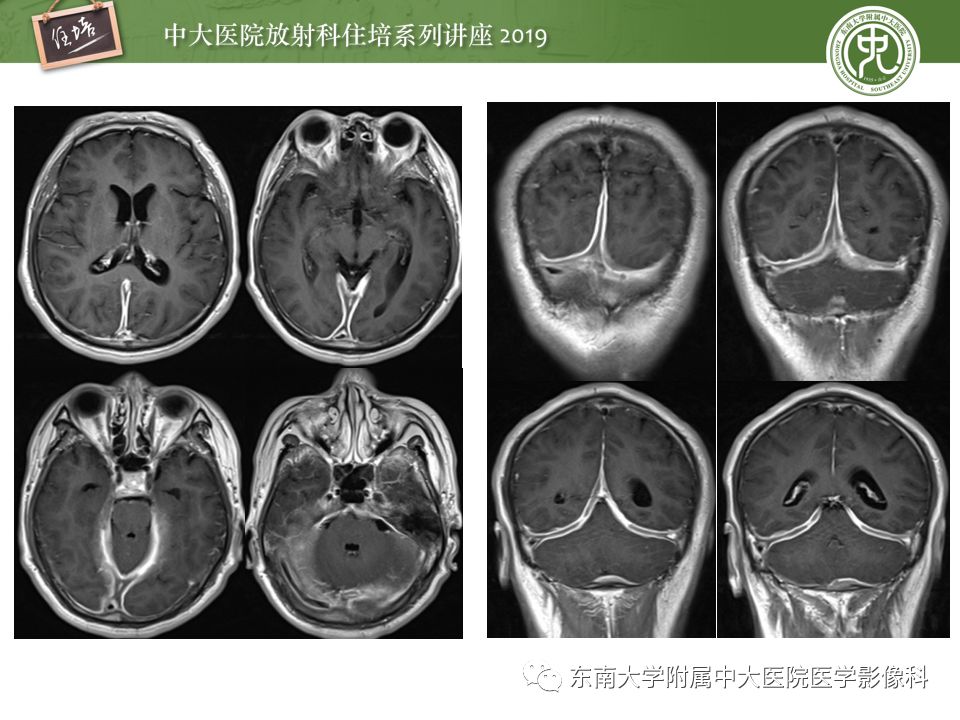 【PPT】脑膜异常强化及相关病变影像表现