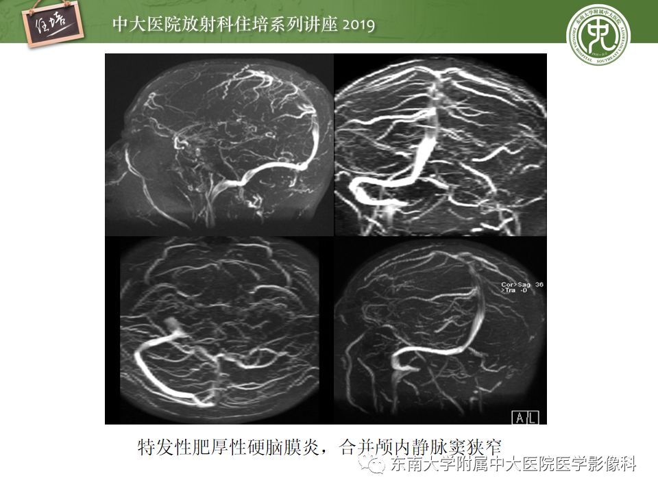 【PPT】脑膜异常强化及相关病变影像表现