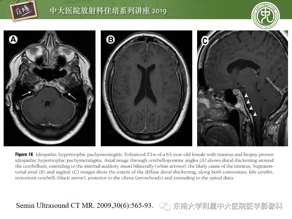 【PPT】脑膜异常强化及相关病变影像表现