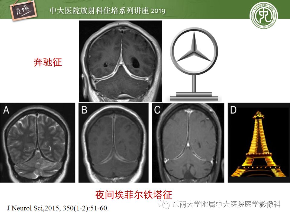 【PPT】脑膜异常强化及相关病变影像表现