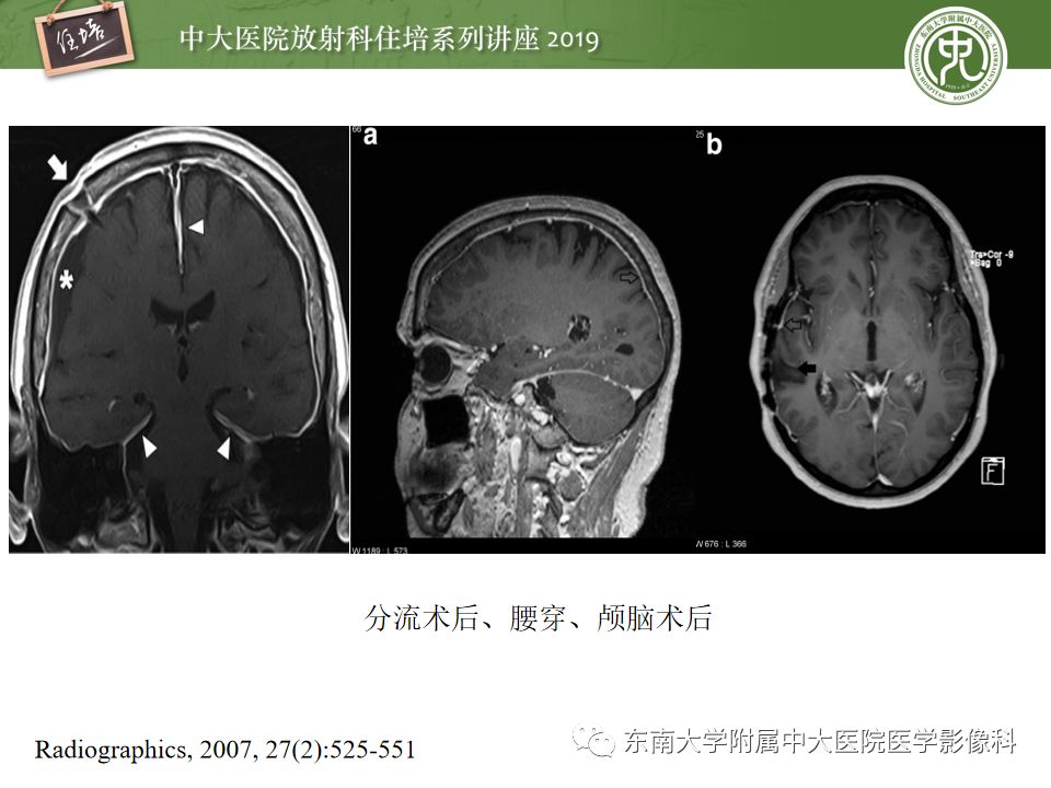 【PPT】脑膜异常强化及相关病变影像表现