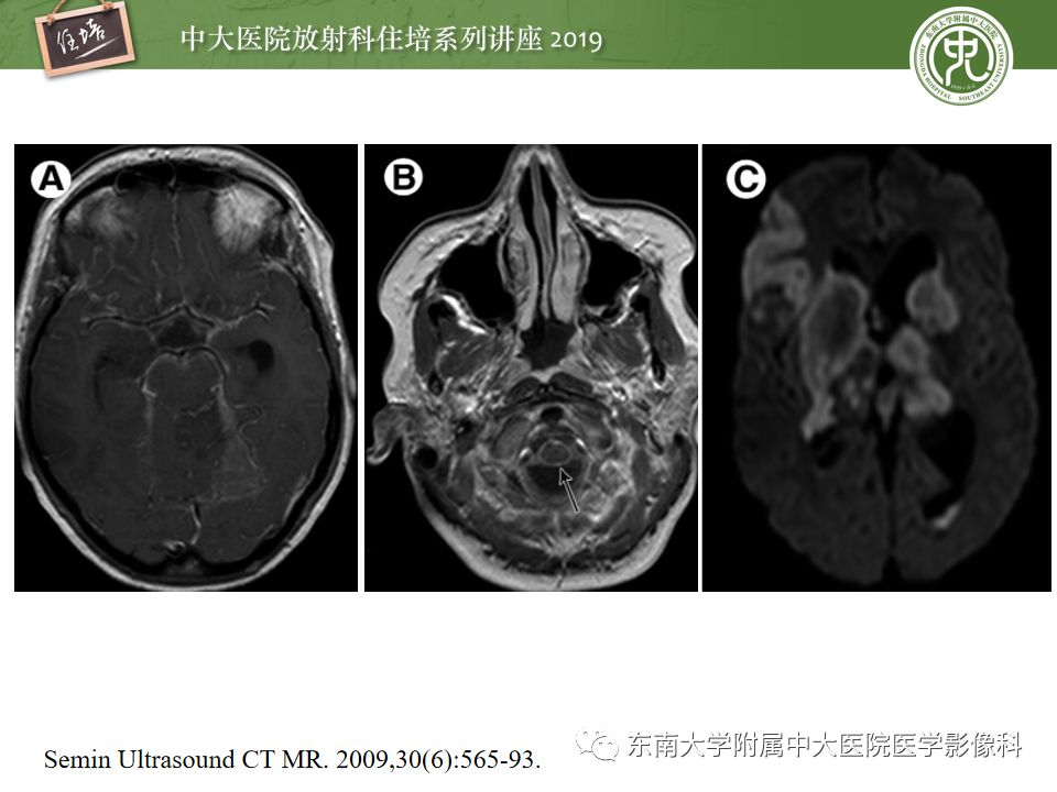 【PPT】脑膜异常强化及相关病变影像表现