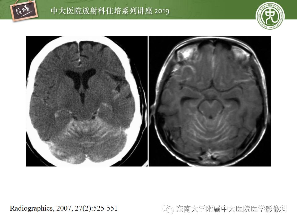 【PPT】脑膜异常强化及相关病变影像表现