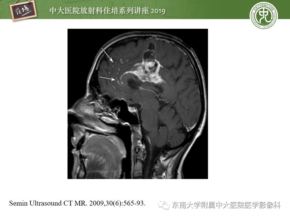 【PPT】脑膜异常强化及相关病变影像表现