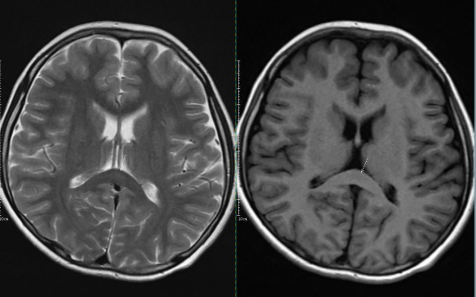 【病例】可逆性胼胝体压部病变综合征2例MR影像诊断思路分析 【病例】可逆性胼胝体压部病变综合征2例MR影像诊断思路分析
