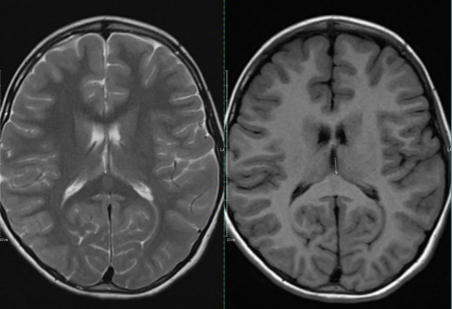 【病例】可逆性胼胝体压部病变综合征2例MR影像诊断思路分析 【病例】可逆性胼胝体压部病变综合征2例MR影像诊断思路分析