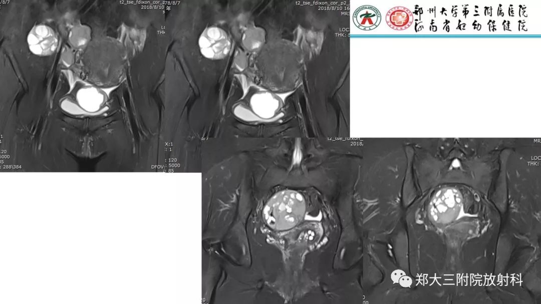 【病例】卵巢颗粒细胞瘤1例MR影像